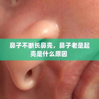 鼻子不断长鼻壳，鼻子老是起壳是什么原因 